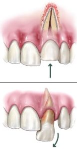 A drawing showcasing a dental trauma.